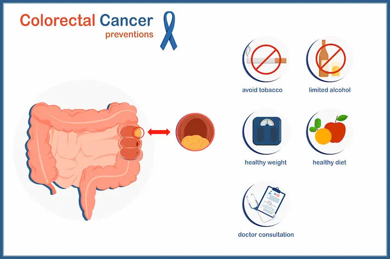 How to Avoid Colon Cancer Effectively?